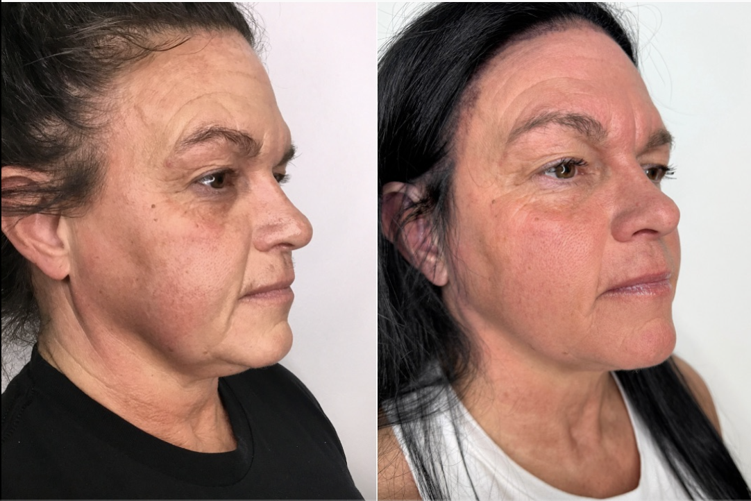 Before and after result 1