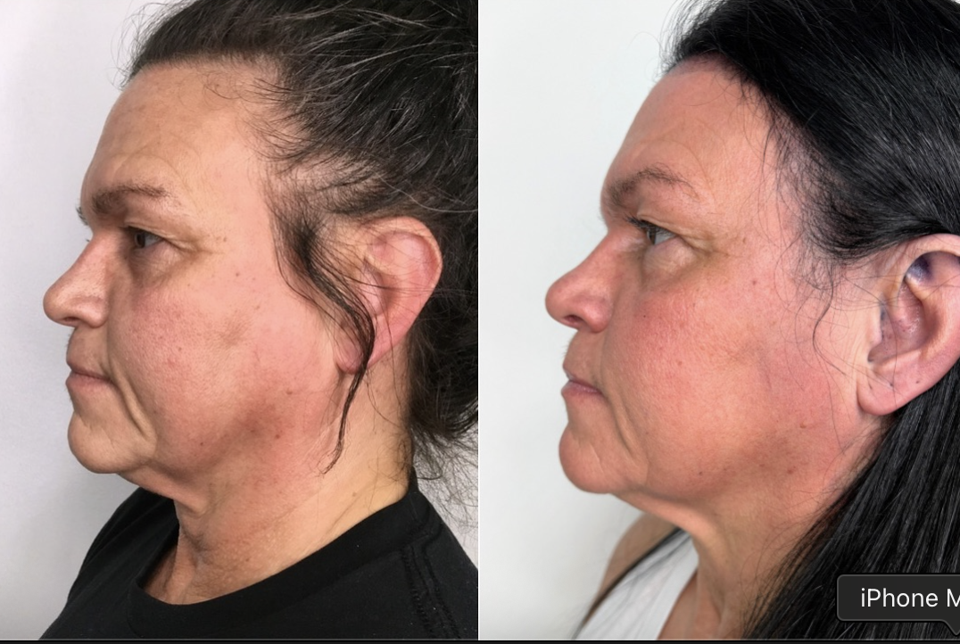 Before and after result 3