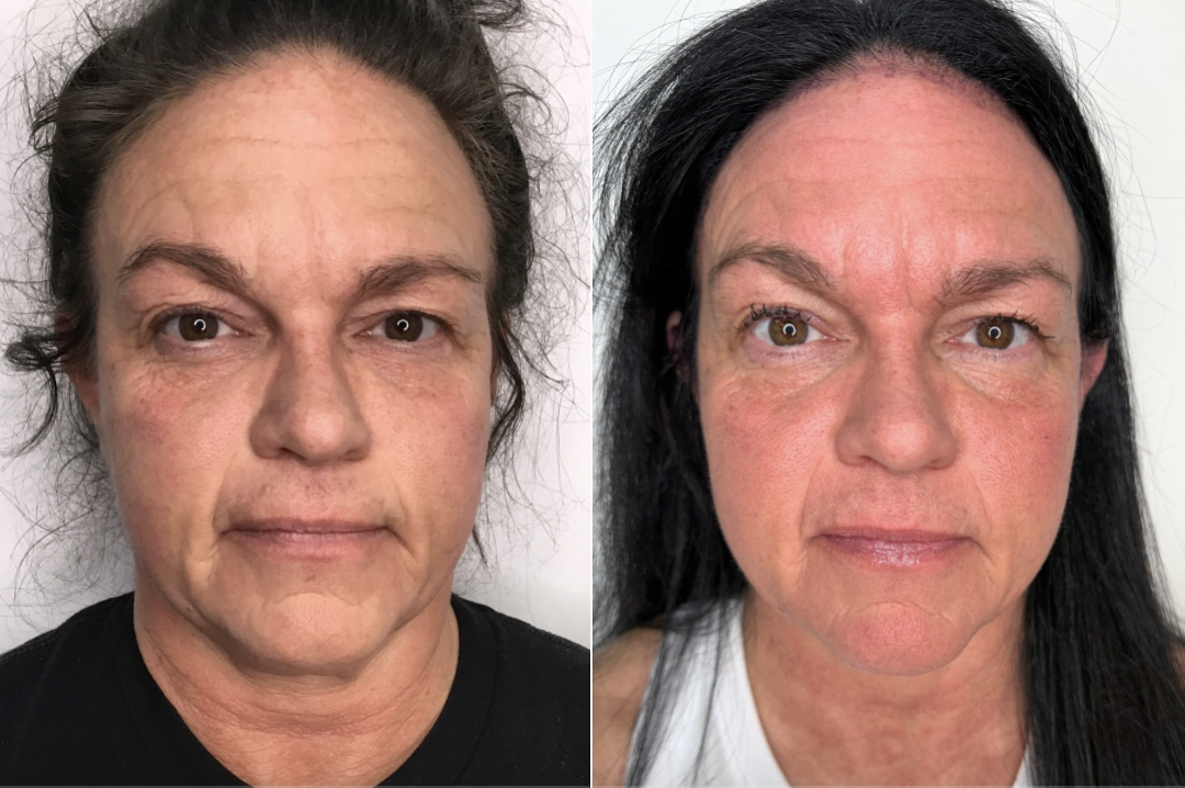 Before and after result 4